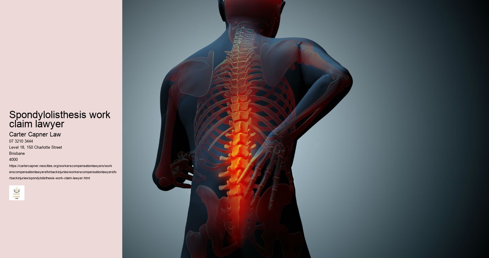 spondylolisthesis work claim lawyer